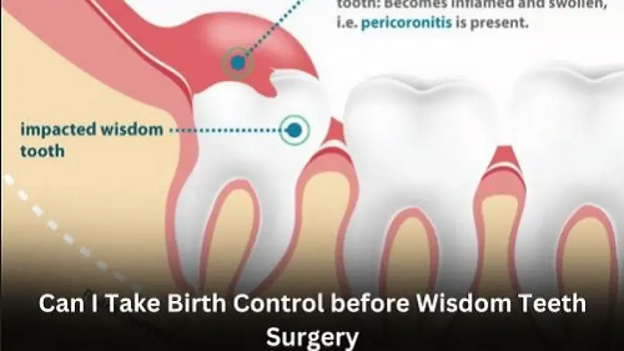 Can I Take Birth Control before wisdom Teeth Surgery
